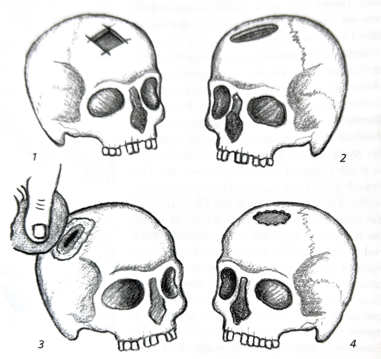 Auf der Abbildung sind vier menschliche Schädel zu sehen, zwei oben, zwei unten. Oben links erkennt man ein quadratisches, gearbeitetes Loch in der Schädeldecke. Oben rechts ein ovales Loch. Unten links hält eine Hand einen Stein an einen Schädel und schabt daran. Unten rechts sieht man ein unregelmäßiges, fransiges Loch.